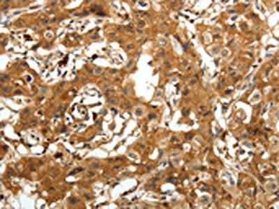 The image on the left is immunohistochemistry of paraffin-embedded Human lung cancer tissue using AMD1 Antibody(AMD1 Antibody) at dilution 1/30, on the right is treated with synthetic peptide. (Original magnification: ×200)Rabbit anti-Human AMD1 Polyclonal Antibody