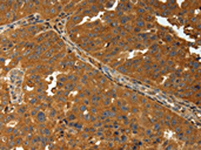 The image on the left is immunohistochemistry of paraffin-embedded Human ovarian cancer tissue using the antibody Antibody) at dilution 1/30, on the right is treated with synthetic peptide. (Original magnification: ×200)Rabbit anti-Human AMD1 Polyclonal Antibody