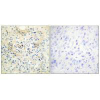 Immunohistochemistry analysis of paraffin-embedded human prostate carcinoma tissue, using TM16G antibody.Rabbit anti-Human ANO7 Polyclonal Antibody