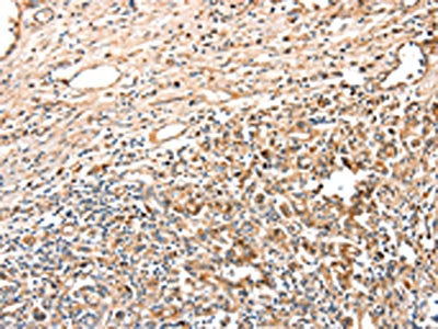 The image on the left is immunohistochemistry of paraffin-embedded Human gastric cancer tissue using ADA Antibody(ADA Antibody) at dilution 1/15, on the right is treated with fusion protein. (Original magnification: ×200)