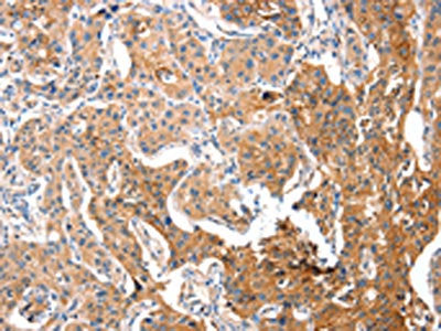 The image on the left is immunohistochemistry of paraffin-embedded Human lung cancer tissue using the antibody Antibody) at dilution 1/15, on the right is treated with fusion protein. (Original magnification: ×200)