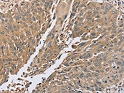 The image on the left is immunohistochemistry of paraffin-embedded Human lung cancer tissue using the antibody Antibody) at dilution 1/45, on the right is treated with synthetic peptide. (Original magnification: ×200)Rabbit anti-Human PTPN12 Polyclonal Antibody