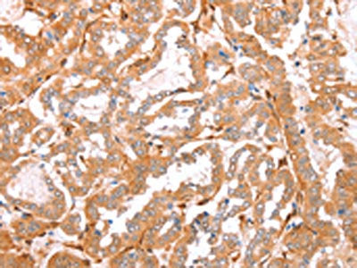 The image on the left is immunohistochemistry of paraffin-embedded Human thyroid cancer tissue using CNN3 Antibody(CNN3 Antibody) at dilution 1/15, on the right is treated with fusion protein. (Original magnification: ×200)Rabbit anti-Human CNN3 Polyclonal Antibody