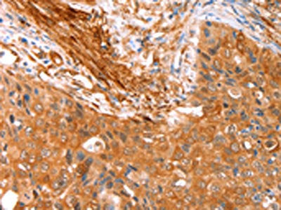 The image on the left is immunohistochemistry of paraffin-embedded Human cervical cancer tissue using the antibody Antibody) at dilution 1/15, on the right is treated with fusion protein. (Original magnification: ×200)Rabbit anti-Human CNN3 Polyclonal Antibody