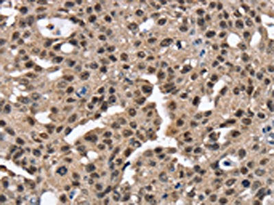 The image on the left is immunohistochemistry of paraffin-embedded Human breast cancer tissue using the antibody Antibody) at dilution 1/25, on the right is treated with fusion protein. (Original magnification: ×200)Rabbit anti-Human RNF40 Polyclonal Antibody