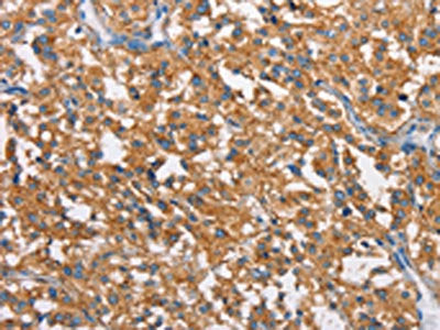 The image on the left is immunohistochemistry of paraffin-embedded Human thyroid cancer tissue using CLTC Antibody(CLTC Antibody) at dilution 1/20, on the right is treated with synthetic peptide. (Original magnification: ×200)Rabbit anti-Human CLTC Polyclonal Antibody
