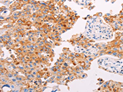 The image on the left is immunohistochemistry of paraffin-embedded Human lung cancer tissue using the antibody Antibody) at dilution 1/25, on the right is treated with synthetic peptide. (Original magnification: ×200)Rabbit anti-Human PLIN2 Polyclonal Antibody