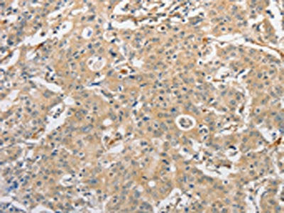 The image on the left is immunohistochemistry of paraffin-embedded Human gastric cancer tissue using ATG3 Antibody(ATG3 Antibody) at dilution 1/30, on the right is treated with fusion protein. (Original magnification: ×200)Rabbit anti-Human ATG3 Polyclonal Antibody