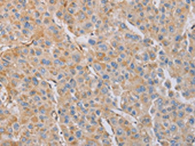The image on the left is immunohistochemistry of paraffin-embedded Human liver cancer tissue using MYL6 Antibody(MYL6 Antibody) at dilution 1/50, on the right is treated with fusion protein. (Original magnification: ×200)Rabbit anti-Human MYL6 Polyclonal Antibody