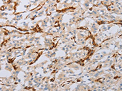 The image on the left is immunohistochemistry of paraffin-embedded Human thyroid cancer tissue using the antibody Antibody) at dilution 1/50, on the right is treated with fusion protein. (Original magnification: ×200)Rabbit anti-Human MYL6 Polyclonal Antibody