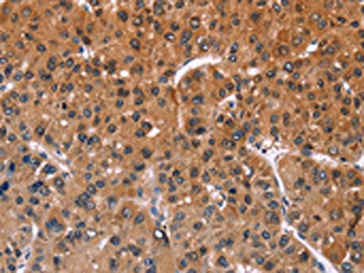 The image on the left is immunohistochemistry of paraffin-embedded Human liver cancer tissue using ING2 Antibody(ING2 Antibody) at dilution 1/40, on the right is treated with fusion protein. (Original magnification: ×200)Rabbit anti-Human ING2 Polyclonal Antibody