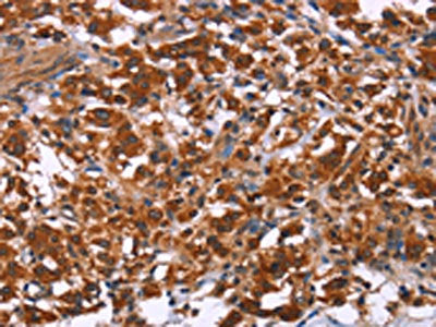 The image on the left is immunohistochemistry of paraffin-embedded Human thyroid cancer tissue using the antibody Antibody) at dilution 1/40, on the right is treated with fusion protein. (Original magnification: ×200)Rabbit anti-Human ING2 Polyclonal Antibody