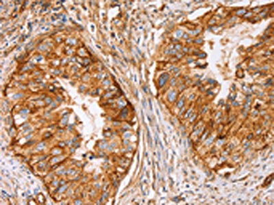 The image on the left is immunohistochemistry of paraffin-embedded Human cervical cancer tissue using CD59 Antibody(CD59 Antibody) at dilution 1/50, on the right is treated with synthetic peptide. (Original magnification: ×200)Rabbit anti-Human CD59 Polyclonal Antibody