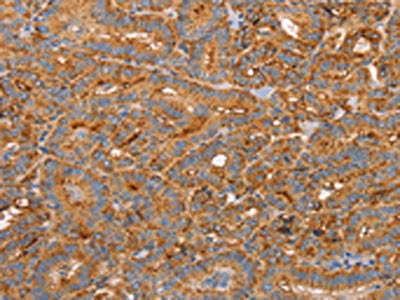 The image on the left is immunohistochemistry of paraffin-embedded Human thyroid cancer tissue using the antibody Antibody) at dilution 1/50, on the right is treated with synthetic peptide. (Original magnification: ×200)Rabbit anti-Human CD59 Polyclonal Antibody