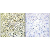 Immunohistochemistry analysis of paraffin-embedded human lung carcinoma tissue using CDKL4 antibody.Rabbit anti-Human CDKL4 Polyclonal Antibody