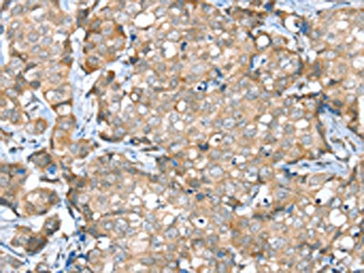 The image on the left is immunohistochemistry of paraffin-embedded Human breast cancer tissue using SESN2 Antibody(SESN2 Antibody) at dilution 1/30, on the right is treated with synthetic peptide. (Original magnification: ×200)Rabbit anti-Human SESN2 Polyclonal Antibody