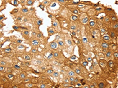 The image on the left is immunohistochemistry of paraffin-embedded Human prostate cancer tissue using the antibody Antibody) at dilution 1/30, on the right is treated with synthetic peptide. (Original magnification: ×200)Rabbit anti-Human SESN2 Polyclonal Antibody