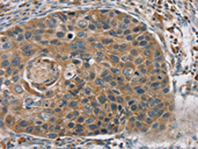 The image on the left is immunohistochemistry of paraffin-embedded Human esophagus cancer tissue using RORB Antibody(RORB Antibody) at dilution 1/35, on the right is treated with synthetic peptide. (Original magnification: ×200)Rabbit anti-Human RORB Polyclonal Antibody