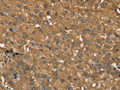 The image on the left is immunohistochemistry of paraffin-embedded Human liver cancer tissue using the antibody Antibody) at dilution 1/35, on the right is treated with synthetic peptide. (Original magnification: ×200)Rabbit anti-Human RORB Polyclonal Antibody