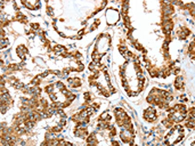 The image on the left is immunohistochemistry of paraffin-embedded Human thyroid cancer tissue using ALDH9A1 Antibody(ALDH9A1 Antibody) at dilution 1/50, on the right is treated with synthetic peptide. (Original magnification: ×200)Rabbit anti-Human ALDH9A1 Polyclonal Antibody