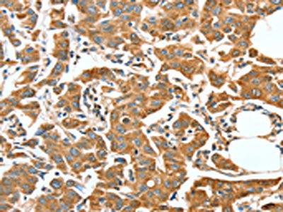 The image on the left is immunohistochemistry of paraffin-embedded Human breast cancer tissue using the antibody Antibody) at dilution 1/50, on the right is treated with synthetic peptide. (Original magnification: ×200)Rabbit anti-Human ALDH9A1 Polyclonal Antibody