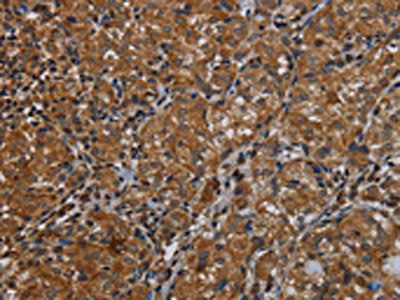 The image on the left is immunohistochemistry of paraffin-embedded Human thyroid cancer tissue using IVL Antibody(IVL Antibody) at dilution 1/50, on the right is treated with synthetic peptide. (Original magnification: ×200)