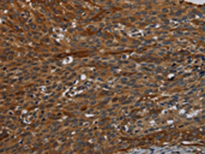 The image on the left is immunohistochemistry of paraffin-embedded Human cervical cancer tissue using the antibody Antibody) at dilution 1/50, on the right is treated with synthetic peptide. (Original magnification: ×200)