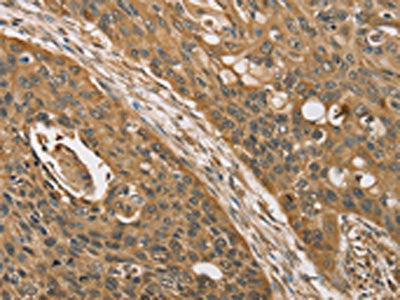 The image on the left is immunohistochemistry of paraffin-embedded Human esophagus cancer tissue using KDM5A Antibody(KDM5A Antibody) at dilution 1/45, on the right is treated with synthetic peptide. (Original magnification: ×200)