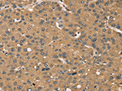 The image on the left is immunohistochemistry of paraffin-embedded Human liver cancer tissue using the antibody Antibody) at dilution 1/45, on the right is treated with synthetic peptide. (Original magnification: ×200)