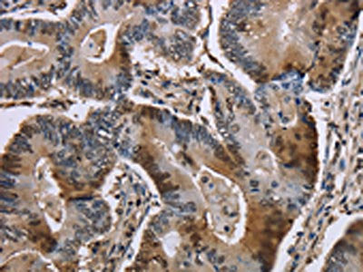 The image is immunohistochemistry of paraffin-embedded Human colon cancer tissue using GAPDH Antibody(GAPDH Antibody) at dilution 1/30. (Original magnification: ×200)Rabbit anti-Human GAPDH Polyclonal Antibody