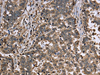 The image is immunohistochemistry of paraffin-embedded Human liver cancer tissue using the antibody Antibody) at dilution 1/30. (Original magnification: ×200)Rabbit anti-Human GAPDH Polyclonal Antibody