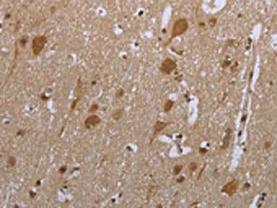 The image is immunohistochemistry of paraffin-embedded Human brain  tissue using SMAD4 Antibody(SMAD4 Antibody) at dilution 1/20. (Original magnification: ×200)Rabbit anti-Human SMAD4 Polyclonal Antibody