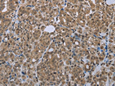 The image is immunohistochemistry of paraffin-embedded Human thyroid cancer tissue using the antibody Antibody) at dilution 1/20. (Original magnification: ×200)Rabbit anti-Human SMAD4 Polyclonal Antibody