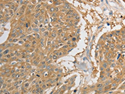 The image on the left is immunohistochemistry of paraffin-embedded Human esophagus cancer tissue using PRDX1 Antibody(PRDX1 Antibody) at dilution 1/20, on the right is treated with synthetic peptide. (Original magnification: ×200)Rabbit anti-Human PRDX1 Polyclonal Antibody