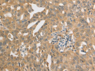 The image on the left is immunohistochemistry of paraffin-embedded Human ovarian cancer tissue using the antibody Antibody) at dilution 1/20, on the right is treated with synthetic peptide. (Original magnification: ×200)Rabbit anti-Human PRDX1 Polyclonal Antibody