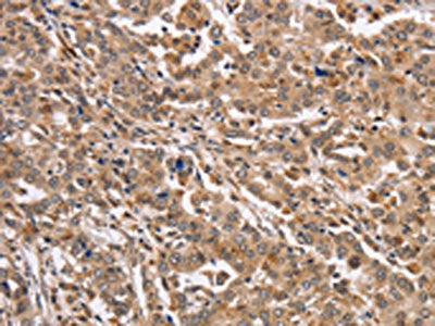 The image on the left is immunohistochemistry of paraffin-embedded Human liver cancer tissue using KCNG2 Antibody(KCNG2 Antibody) at dilution 1/40, on the right is treated with synthetic peptide. (Original magnification: ×200)