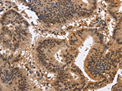 The image on the left is immunohistochemistry of paraffin-embedded Human colon cancer tissue using the antibody Antibody) at dilution 1/40, on the right is treated with synthetic peptide. (Original magnification: ×200)