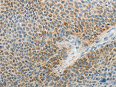 The image on the left is immunohistochemistry of paraffin-embedded Human liver cancer tissue using AGAP1 Antibody(AGAP1 Antibody) at dilution 1/25, on the right is treated with synthetic peptide. (Original magnification: ×200)