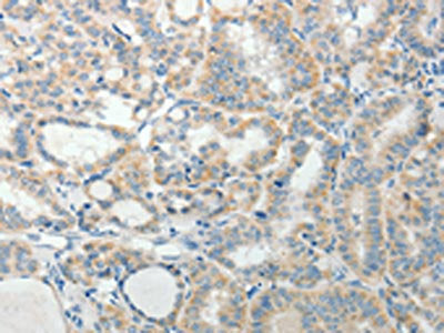 The image on the left is immunohistochemistry of paraffin-embedded Human thyroid cancer tissue using the antibody Antibody) at dilution 1/25, on the right is treated with synthetic peptide. (Original magnification: ×200)