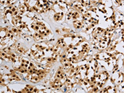 The image on the left is immunohistochemistry of paraffin-embedded Human thyroid cancer tissue using HIST1H2AB Antibody(HIST1H2AB Antibody) at dilution 1/20, on the right is treated with synthetic peptide. (Original magnification: ×200)Rabbit anti-Human HIST1H2AB Polyclonal Antibody