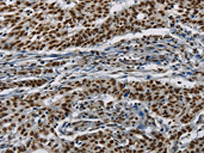 The image on the left is immunohistochemistry of paraffin-embedded Human gastic cancer tissue using the antibody Antibody) at dilution 1/20, on the right is treated with synthetic peptide. (Original magnification: ×200)Rabbit anti-Human HIST1H2AB Polyclonal Antibody