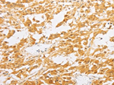 The image on the left is immunohistochemistry of paraffin-embedded Human thyroid cancer tissue using PDE4D Antibody(PDE4D Antibody) at dilution 1/20, on the right is treated with fusion protein. (Original magnification: ×200)Rabbit anti-Human PDE4D Polyclonal Antibody