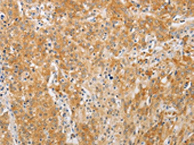 The image on the left is immunohistochemistry of paraffin-embedded Human gastic cancer tissue using the antibody Antibody) at dilution 1/20, on the right is treated with fusion protein. (Original magnification: ×200)Rabbit anti-Human PDE4D Polyclonal Antibody