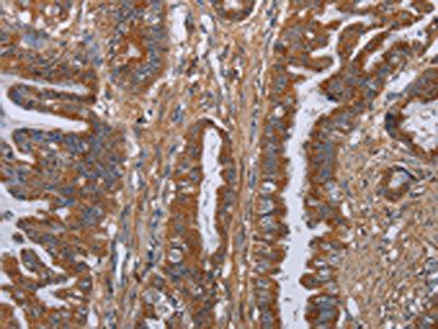 The image on the left is immunohistochemistry of paraffin-embedded Human esophagus cancer tissue using the antibody Antibody) at dilution 1/40, on the right is treated with fusion protein. (Original magnification: ×200)
