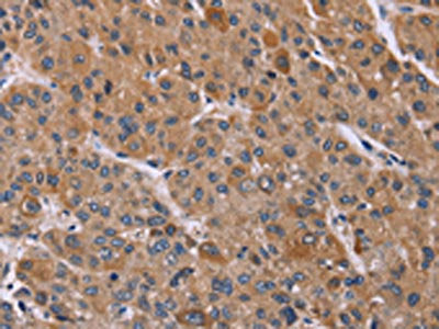 The image on the left is immunohistochemistry of paraffin-embedded Human liver cancer tissue using PPIF Antibody(PPIF Antibody) at dilution 1/45, on the right is treated with fusion protein. (Original magnification: ×200)Rabbit anti-Human PPIF Polyclonal Antibody