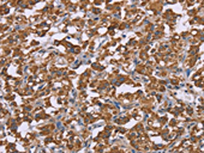 The image on the left is immunohistochemistry of paraffin-embedded Human thyroid cancer tissue using the antibody Antibody) at dilution 1/45, on the right is treated with fusion protein. (Original magnification: ×200)Rabbit anti-Human PPIF Polyclonal Antibody