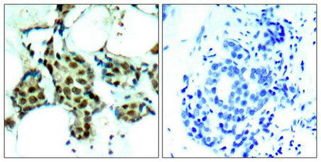 Immunohistochemical analysis of paraffin-embedded human breast carcinoma tissue using P38 MAPK(Phospho-Tyr182) Antibody(left) or the same antibody preincubated with blocking peptide(right).
