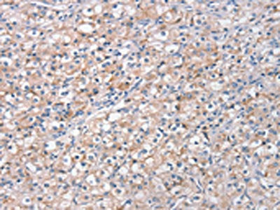 The image on the left is immunohistochemistry of paraffin-embedded Human prostate cancer tissue using STK16 Antibody(STK16 Antibody) at dilution 1/30, on the right is treated with fusion protein. (Original magnification: ×200)Rabbit anti-Human STK16 Polyclonal Antibody