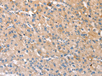 The image on the left is immunohistochemistry of paraffin-embedded Human liver cancer tissue using the antibody Antibody) at dilution 1/30, on the right is treated with fusion protein. (Original magnification: ×200)Rabbit anti-Human STK16 Polyclonal Antibody
