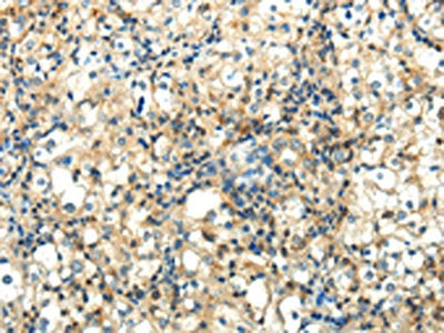 The image on the left is immunohistochemistry of paraffin-embedded Human prostate cancer tissue using WNT2 Antibody(WNT2 Antibody) at dilution 1/40, on the right is treated with synthetic peptide. (Original magnification: ×200)Rabbit anti-Human WNT2 Polyclonal Antibody